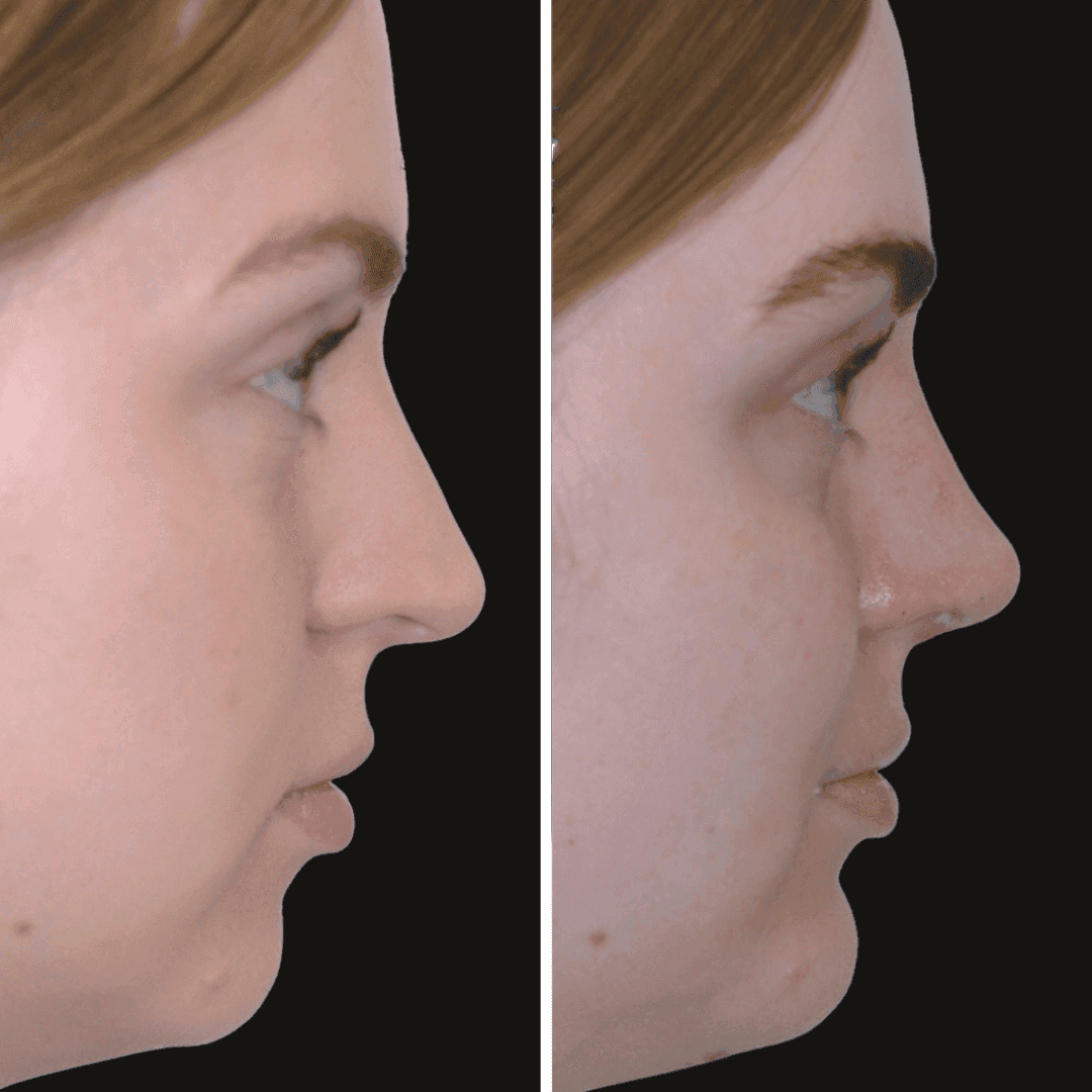 Abby b/a nose and chin