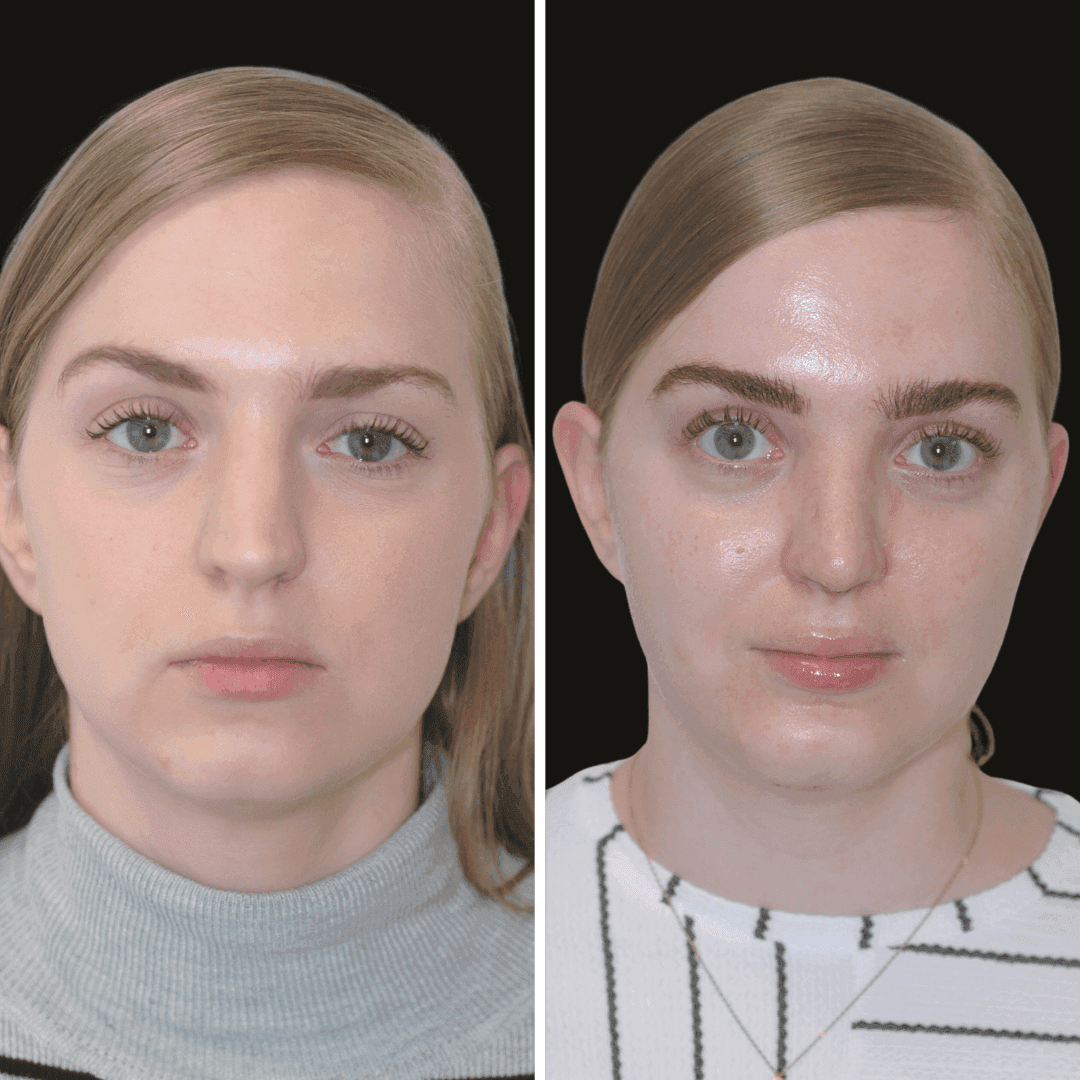 Abby b/a nose and chin