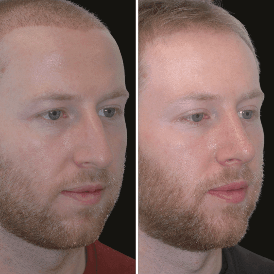 DANIEL RHINOPLASTY B/A