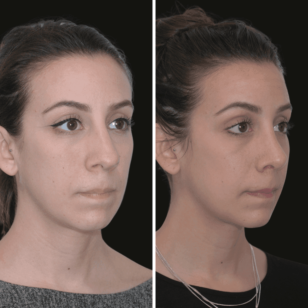 Charlotte RHINOPLASTY B/A