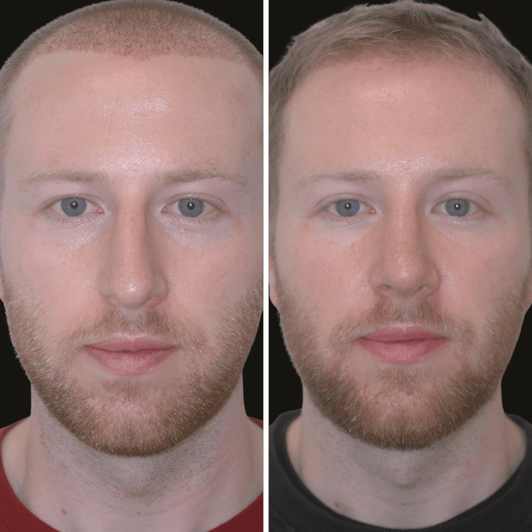 DANIEL RHINOPLASTY B/A