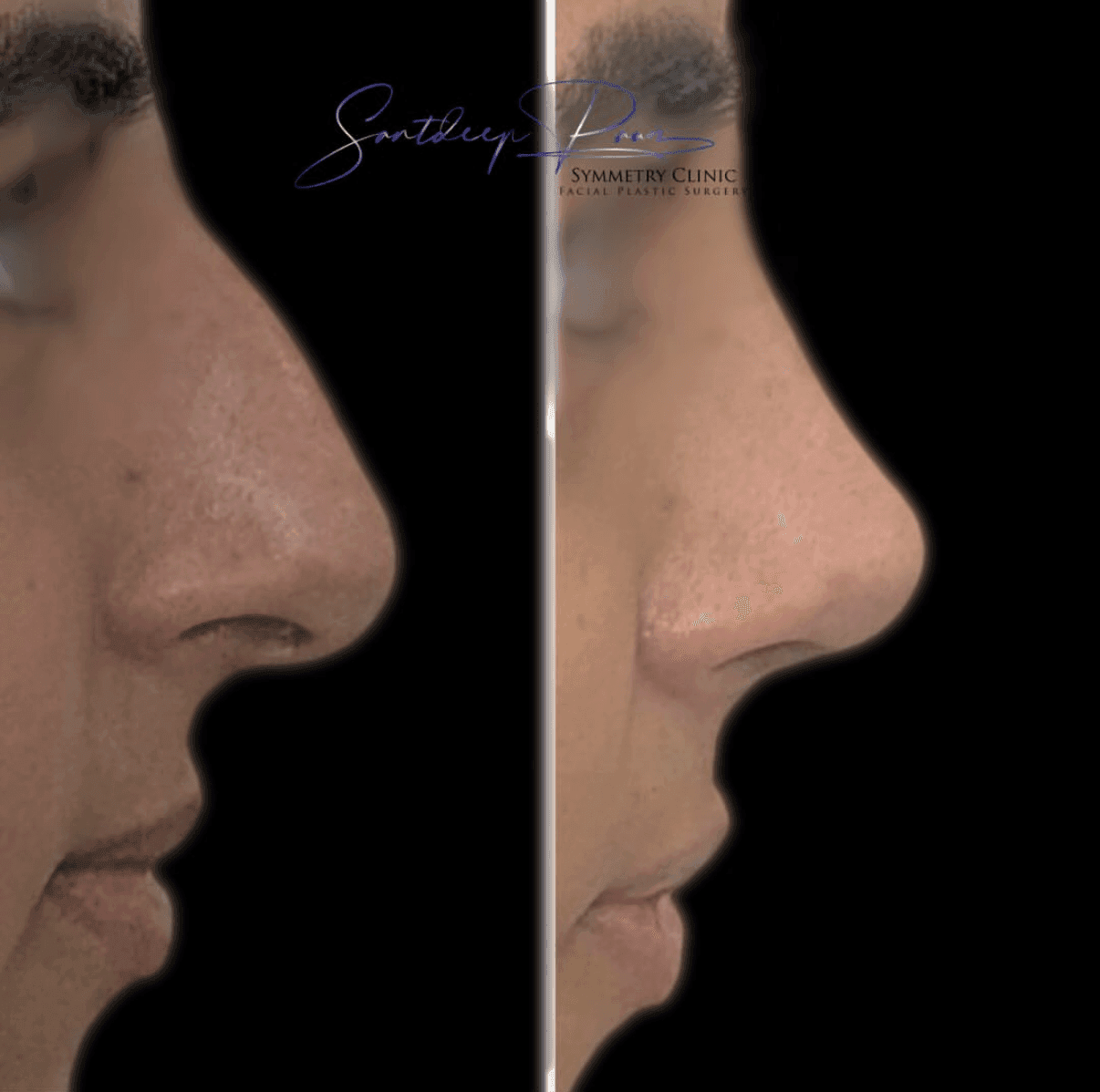 Rhinoplasty Before & After 1
