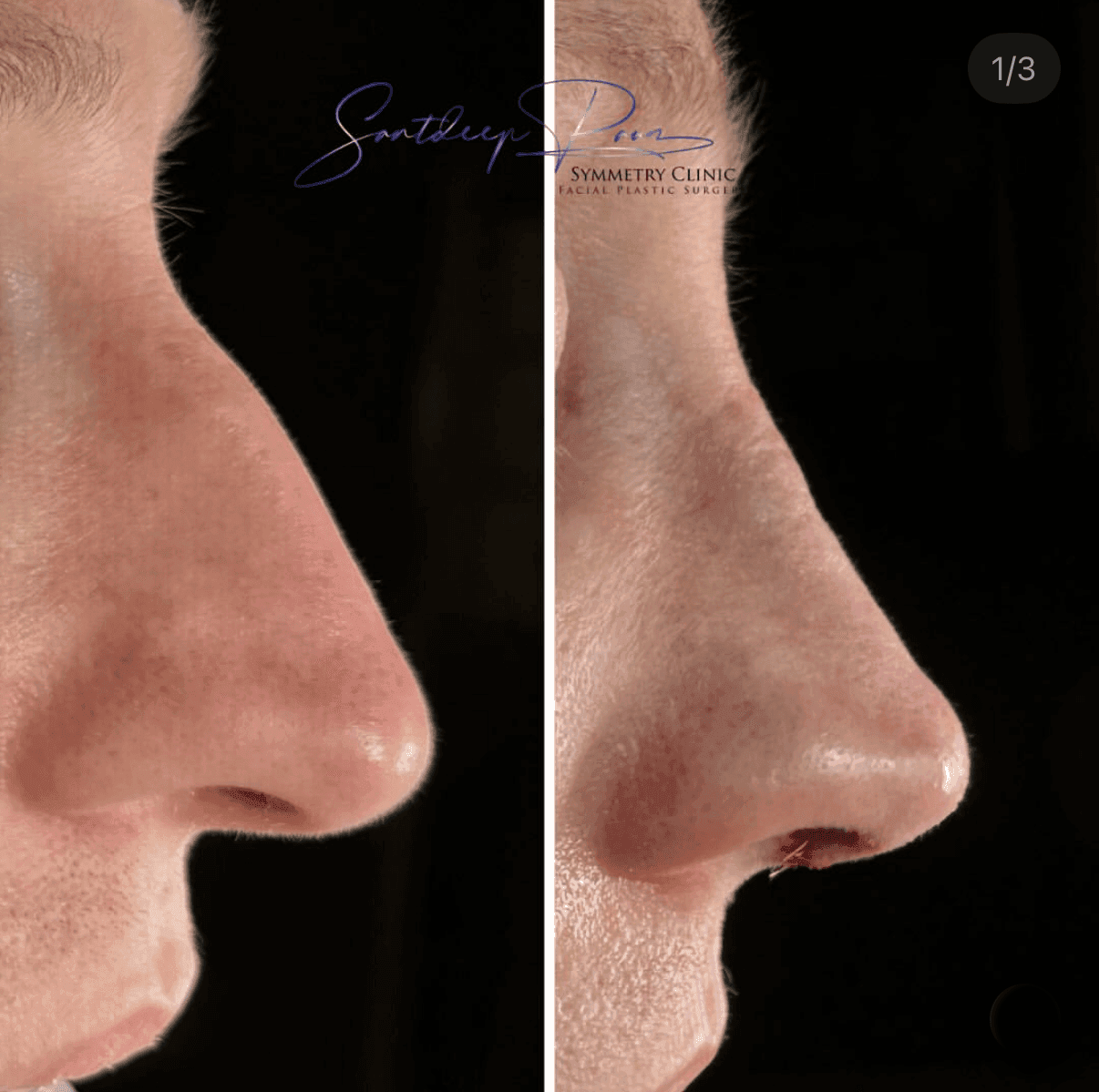 Rhinoplasty Before & After 2