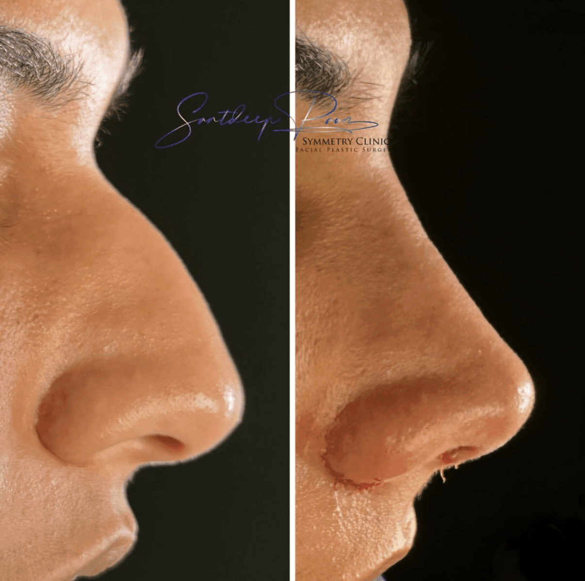 Rhinoplasty Before & After 5
