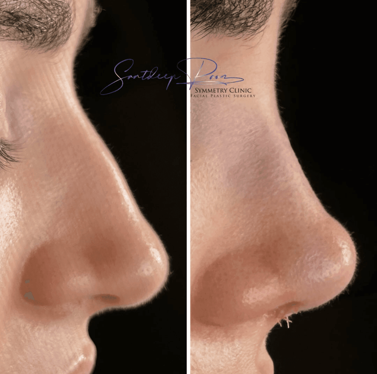 Rhinoplasty Before & After 4