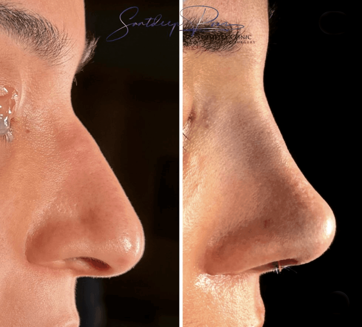 Rhinoplasty Before & After 6
