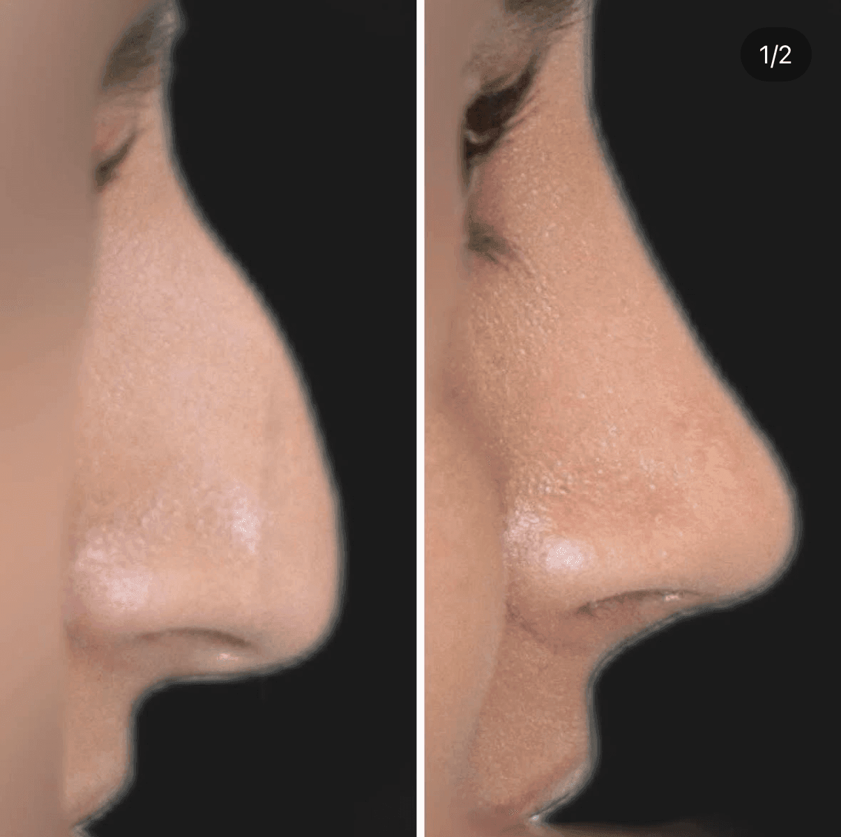 Rhinoplasty Before & After 3