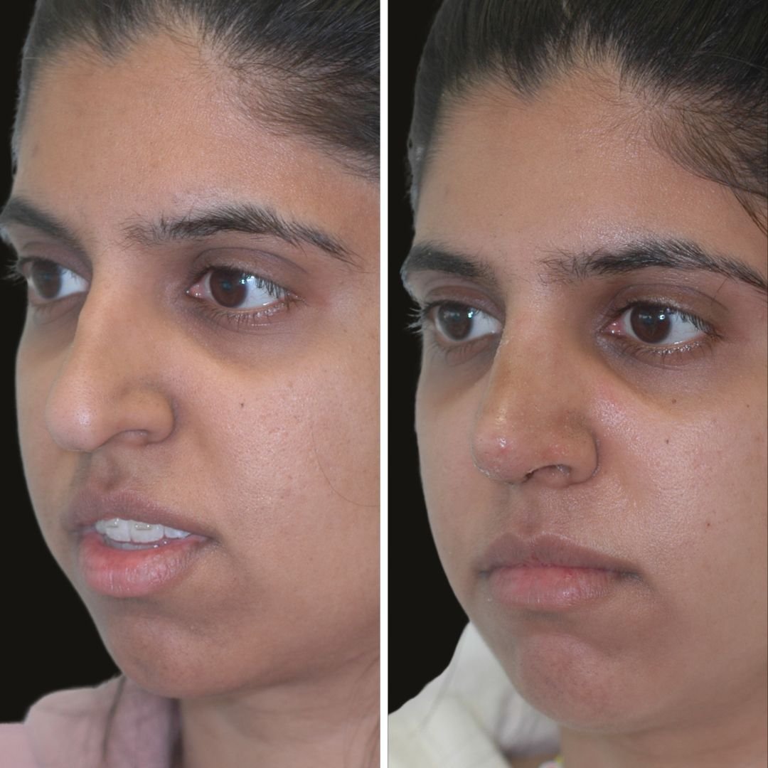 rhinoplasty b/a