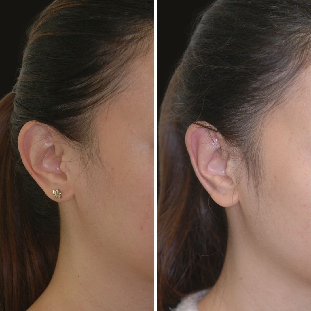 otoplasty b/a