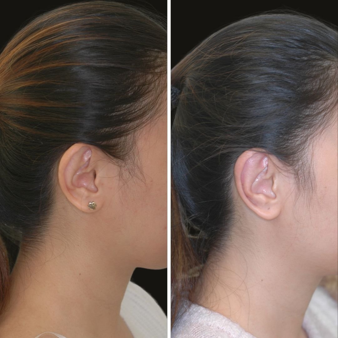 otoplasty b/a