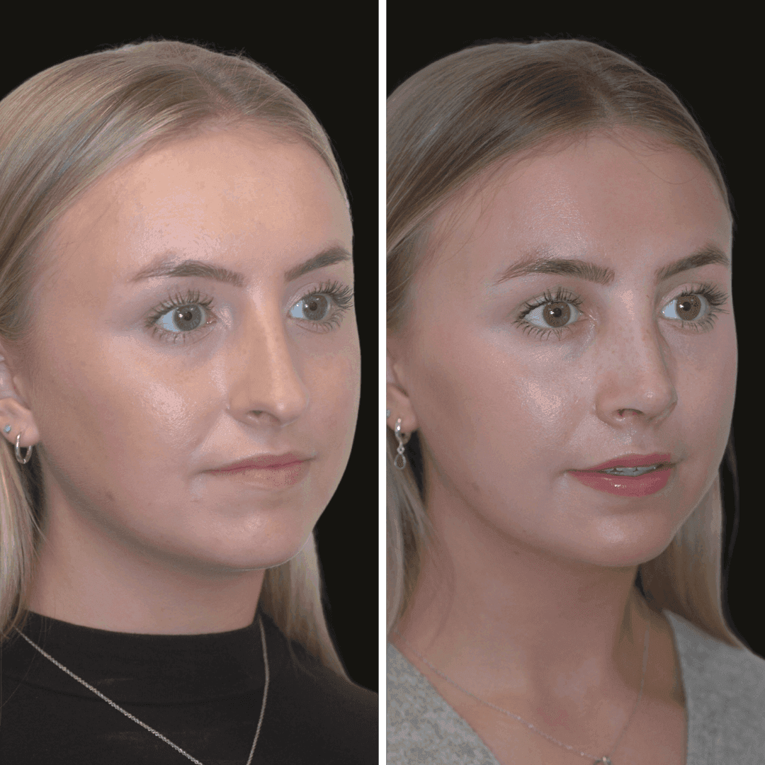 AISLING b/a nose
