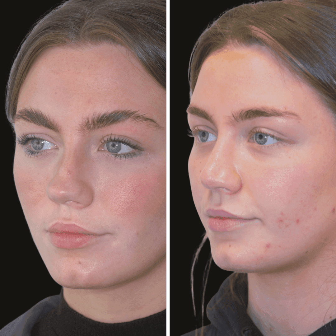 AISLING b/a nose