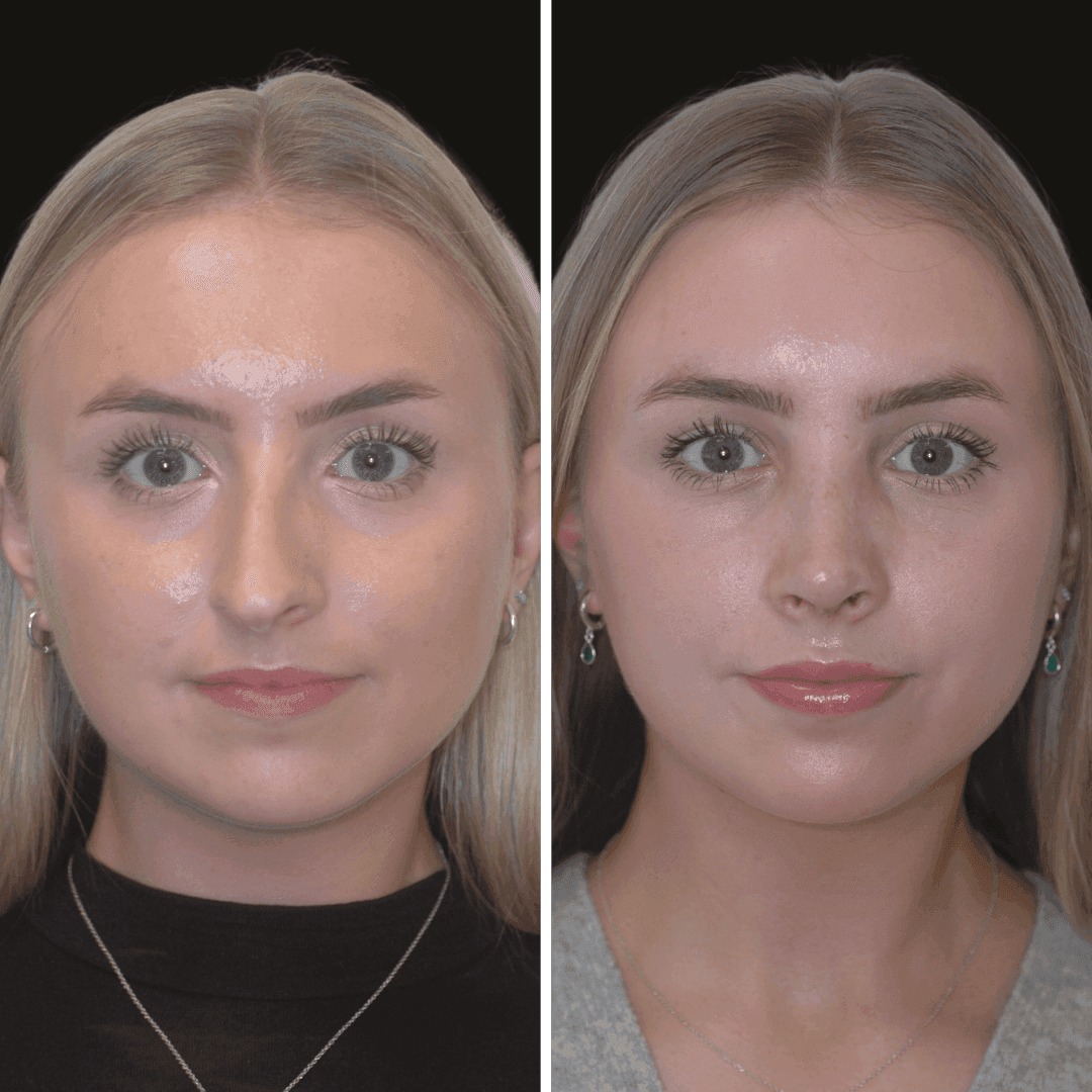 AISLING b/a nose