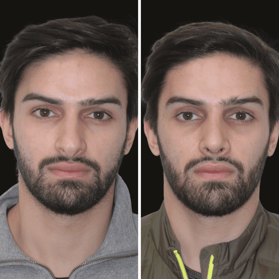 jason b/a rhinoplasty