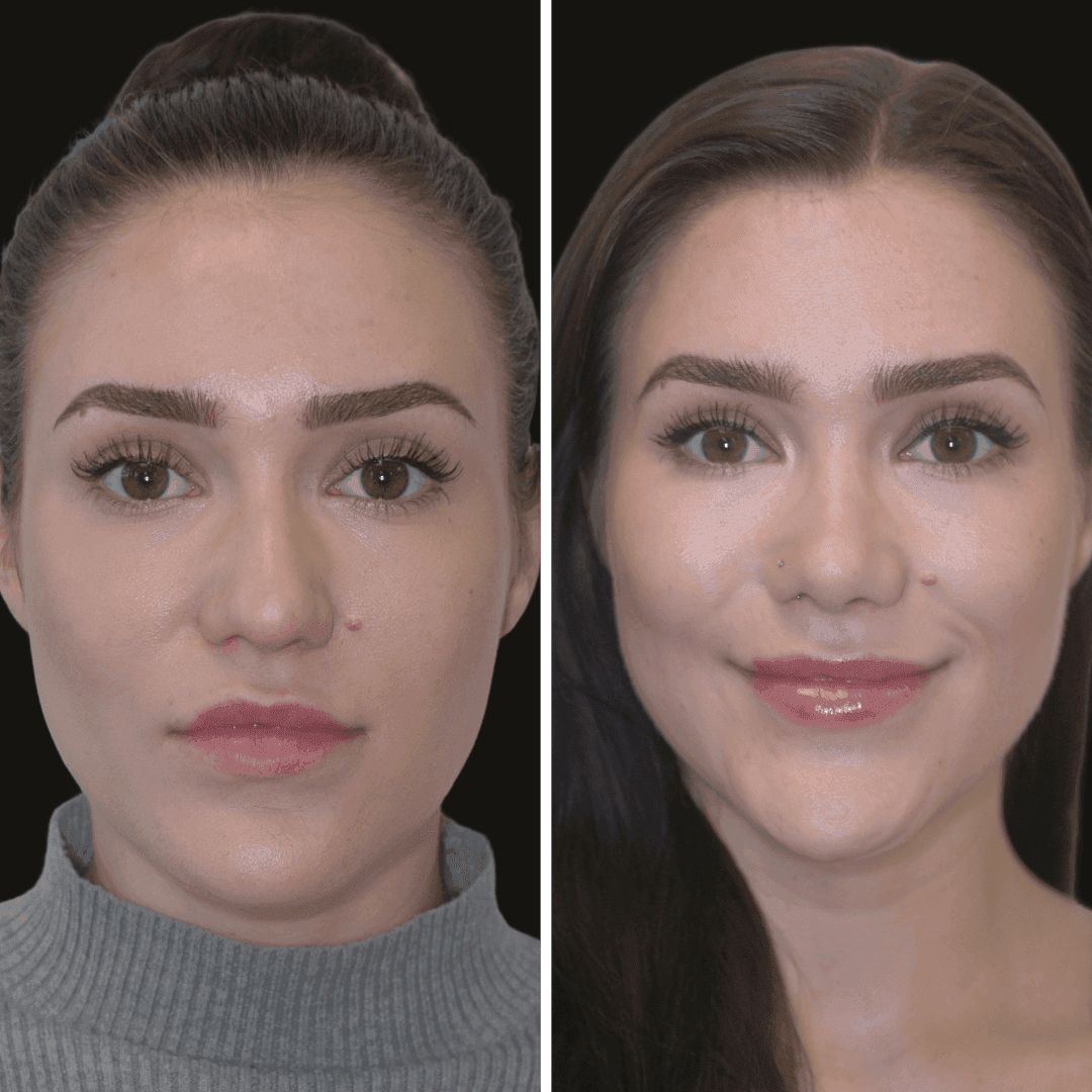 ellie b/a rhinoplasty