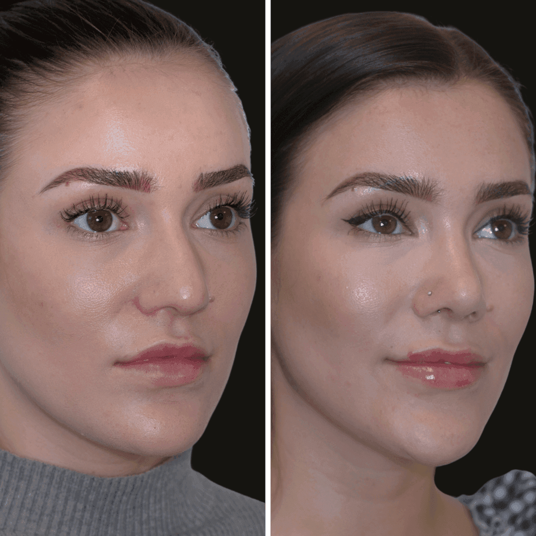 ellie b/a rhinoplasty
