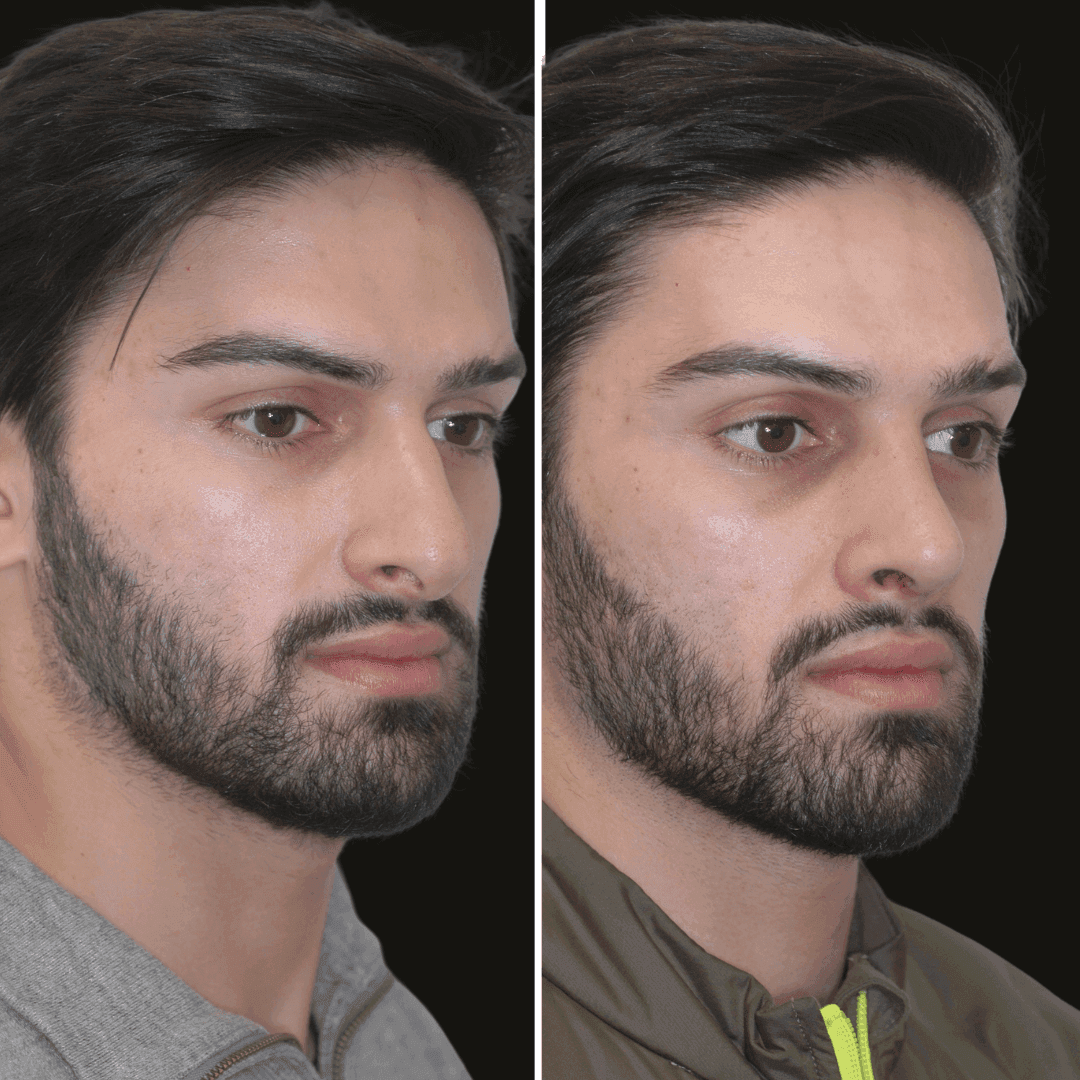 jason b/a rhinoplasty