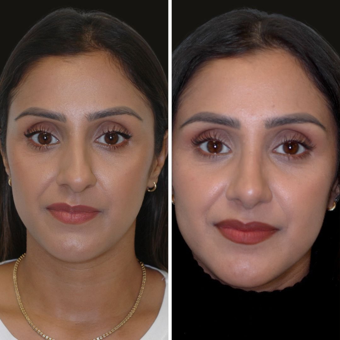 Kiran G b/a rhinoplasty (colour).jpg