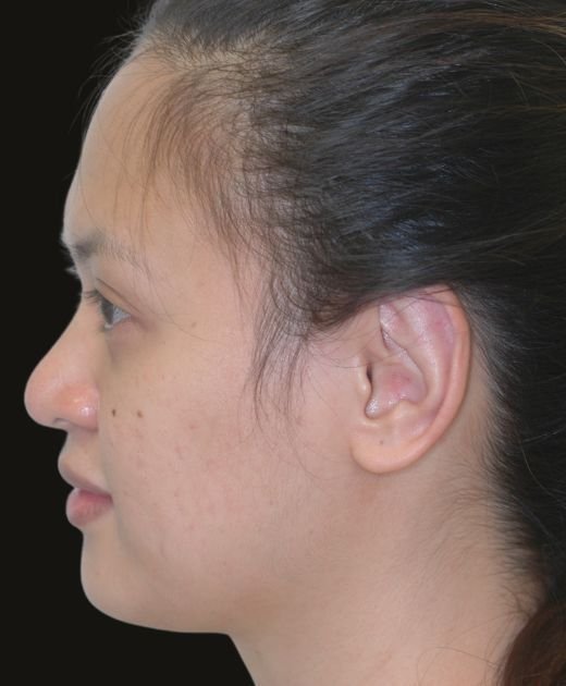 after otoplasty 